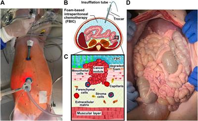 Intraoperative parameters and postoperative follow-up of foam-based intraperitoneal chemotherapy (FBIC)